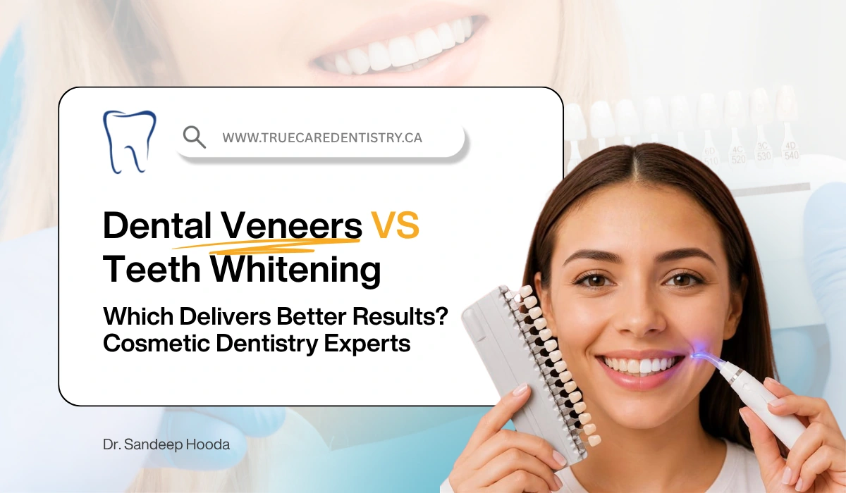 Dental Veneers vs Teeth Whitening